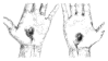stigmata